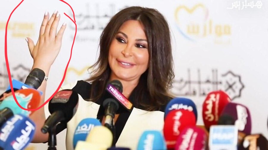 يد اليسا بعد العلاج